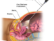 IVF in Delhi