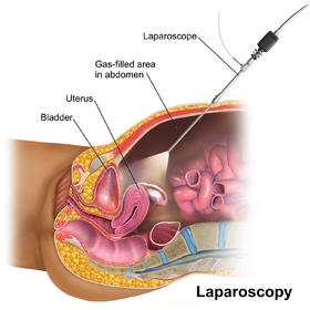 IVF in Delhi